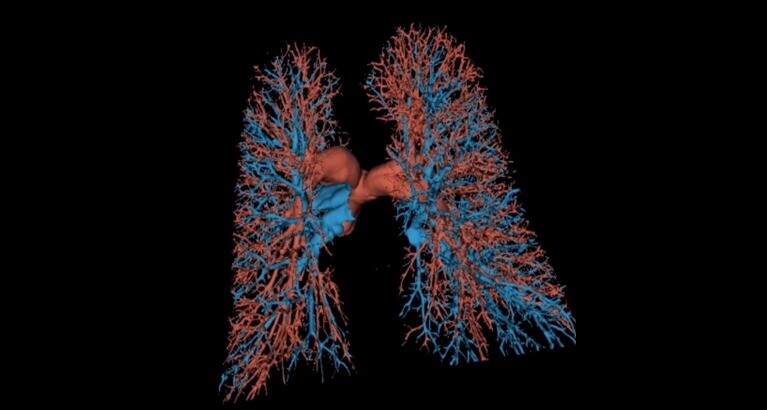 Lung scan image.