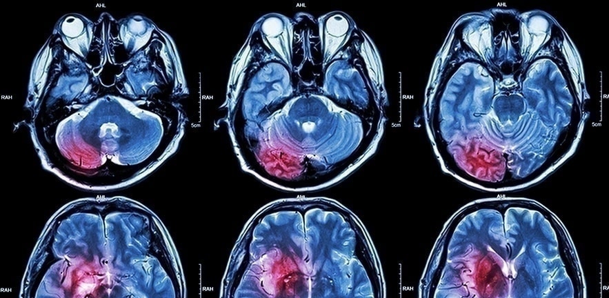 What if a stroke could be diagnosed before a patient’s arrival at hospital?