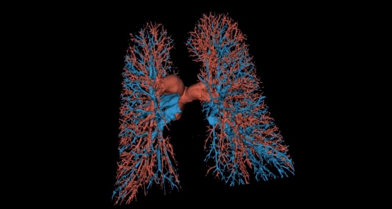 Lung scan image.